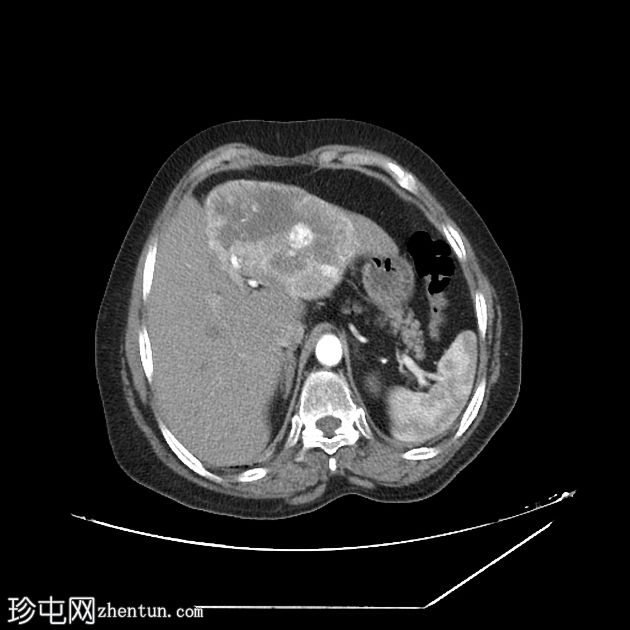 肝转移-滤泡性甲状腺癌