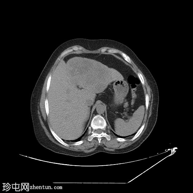 肝转移-滤泡性甲状腺癌