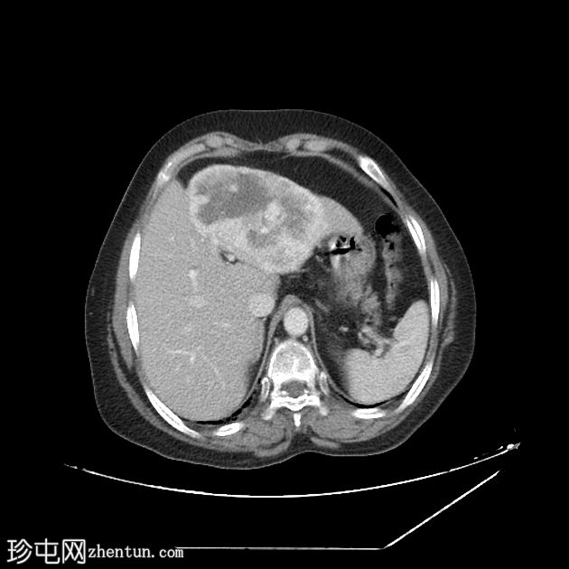 肝转移-滤泡性甲状腺癌