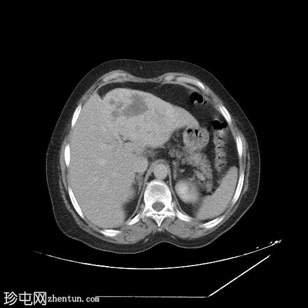 肝转移-滤泡性甲状腺癌