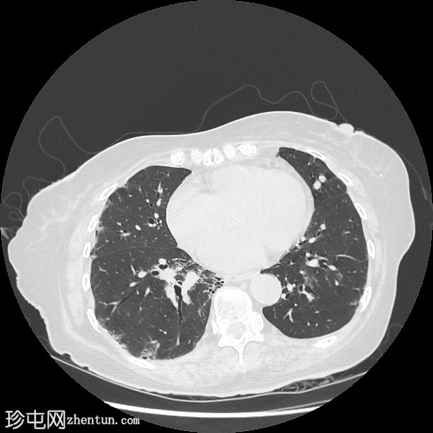 肺动静脉畸形