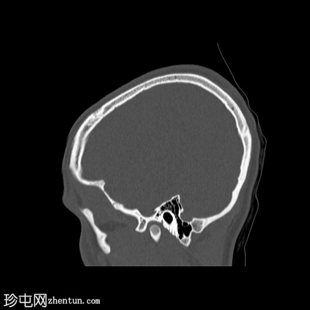 双侧后髁管