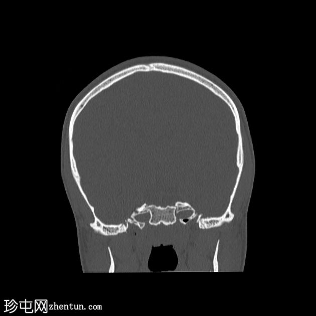 双侧后髁管