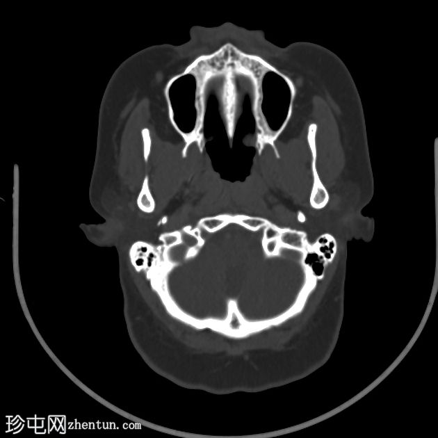 葡萄肿