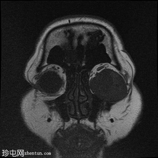 眼眶神经鞘瘤