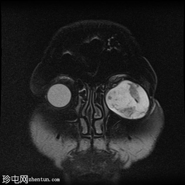 眼眶神经鞘瘤