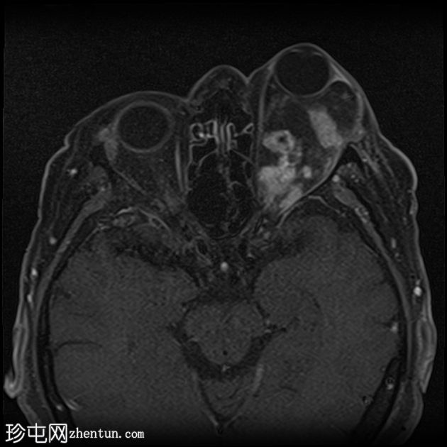 眼眶神经鞘瘤