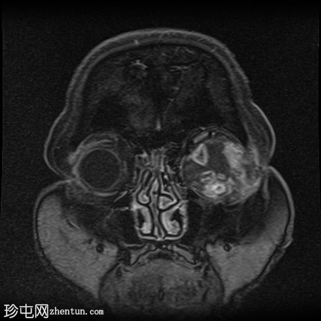 眼眶神经鞘瘤