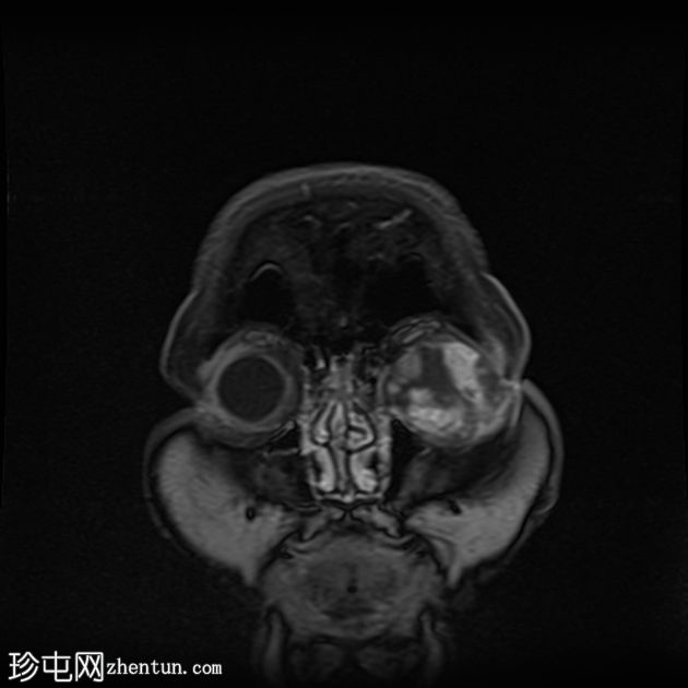 眼眶神经鞘瘤
