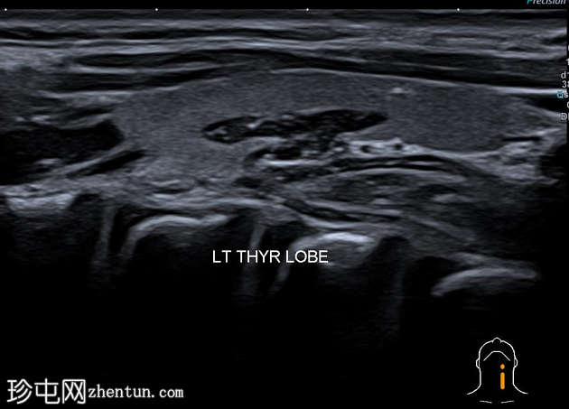 甲状腺内的异位胸腺组织