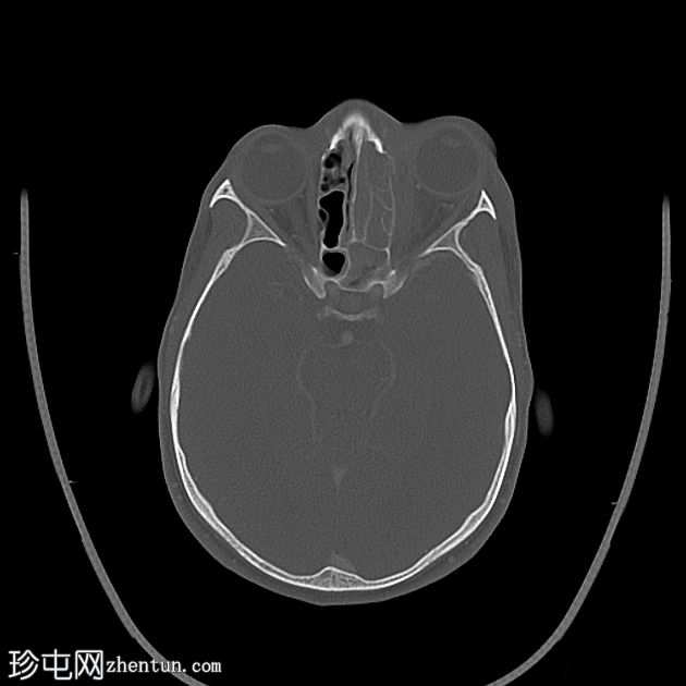 侵袭性真菌性鼻窦炎