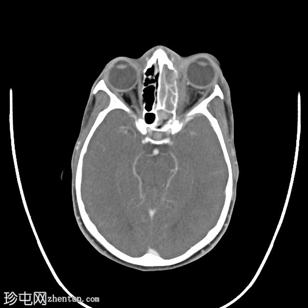 侵袭性真菌性鼻窦炎