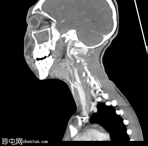 侵袭性真菌性鼻窦炎