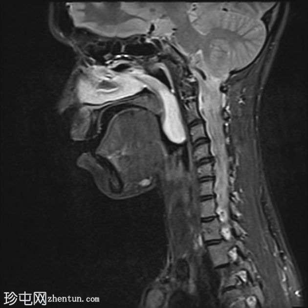 上颌窦后鼻孔息肉