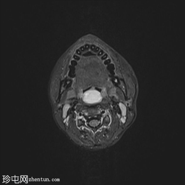 上颌窦后鼻孔息肉