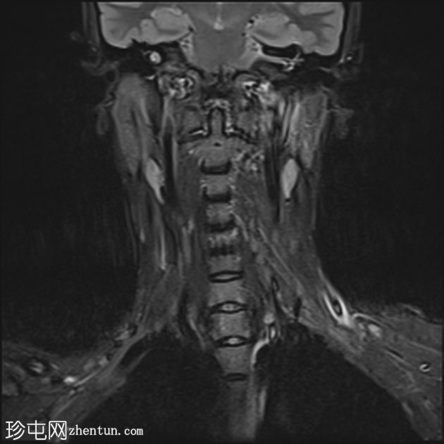 上颌窦后鼻孔息肉