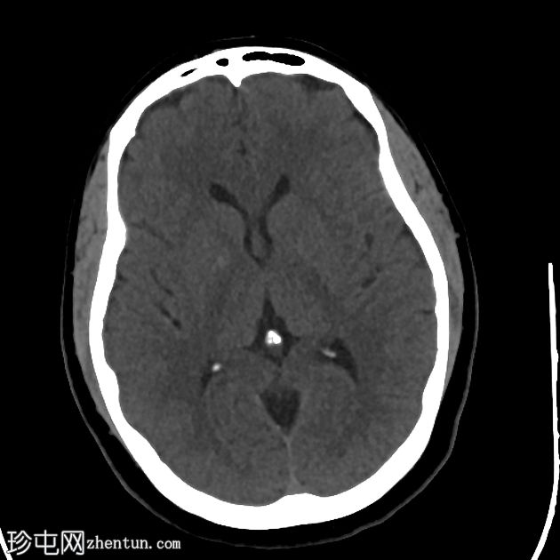 颈长肌钙化性肌腱炎