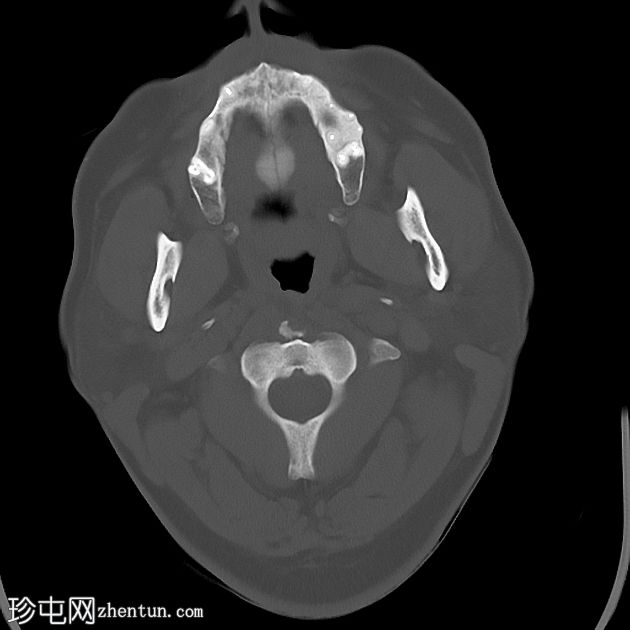 颈长肌钙化性肌腱炎