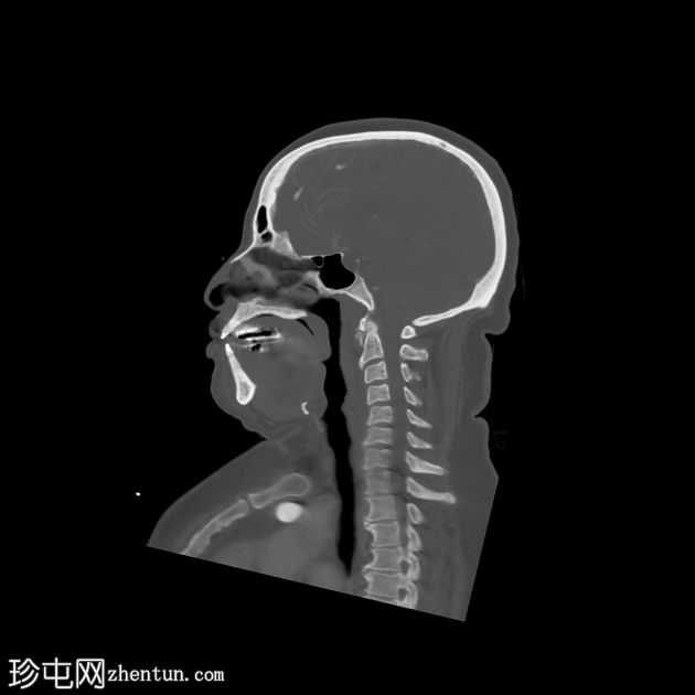 颈长肌钙化性肌腱炎