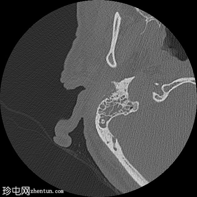 坏死性外耳炎