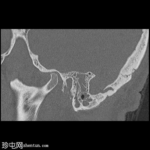 坏死性外耳炎