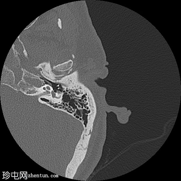 坏死性外耳炎