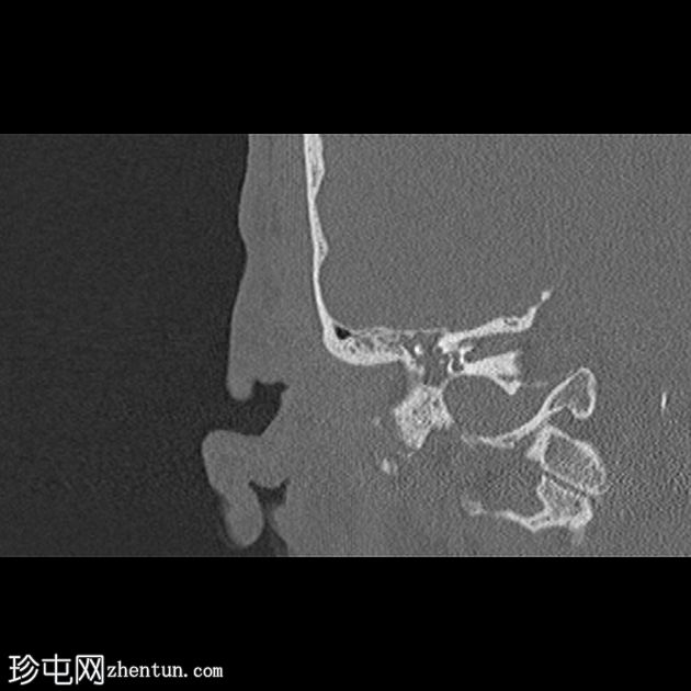 坏死性外耳炎