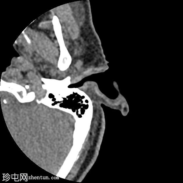 坏死性外耳炎