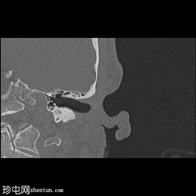 坏死性外耳炎