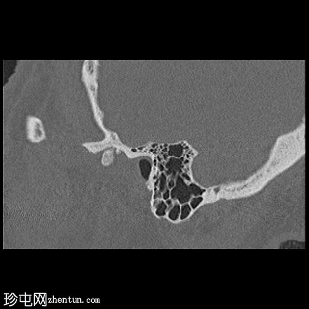 坏死性外耳炎