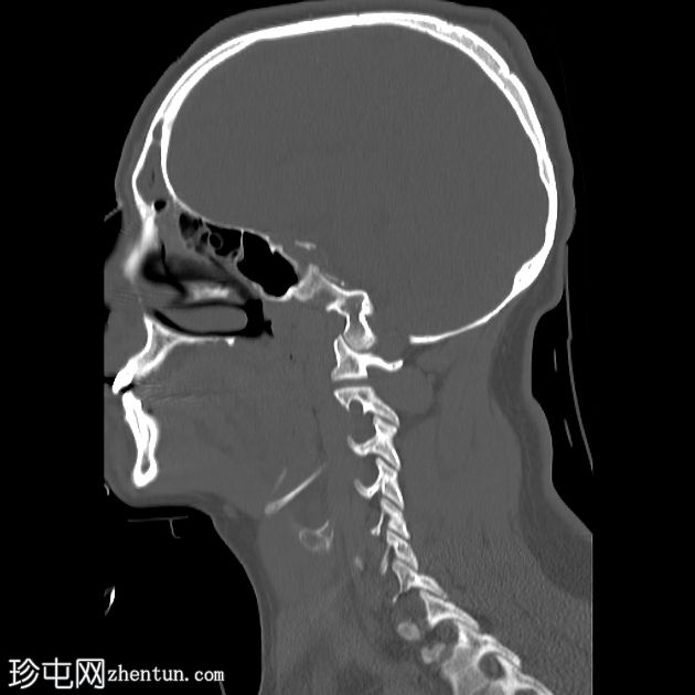 鼻气囊增生症伴额窦疾病