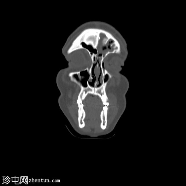 鼻气囊增生症伴额窦疾病