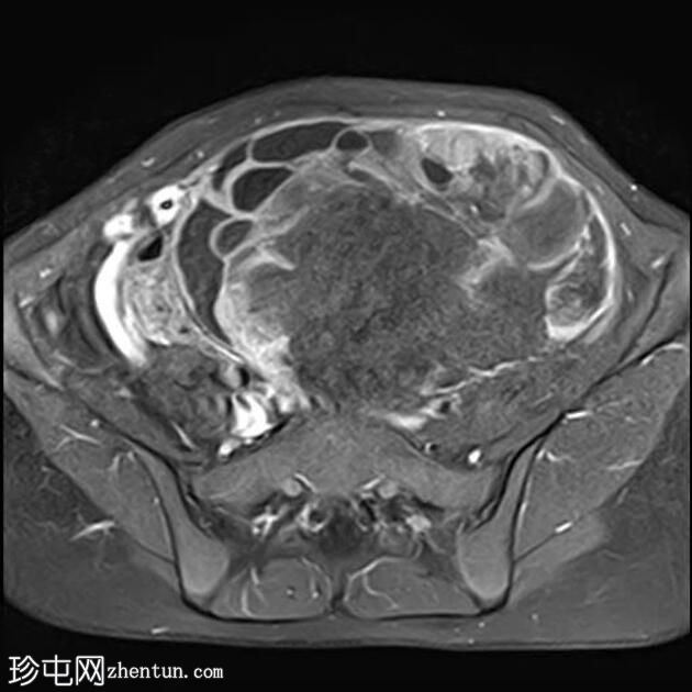 卵巢幼年性颗粒细胞瘤（JGCT）