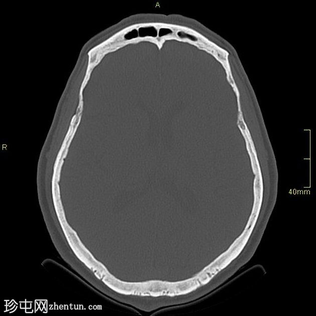 颅底纤维发育不良 - 斜坡