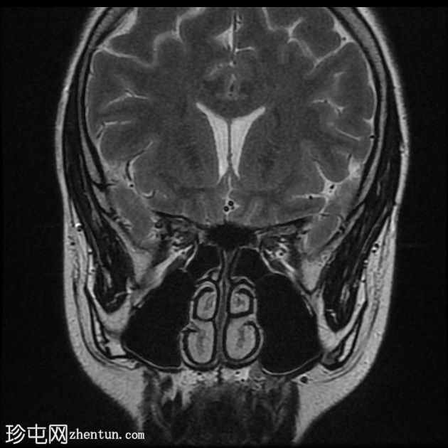 席-汉综合征