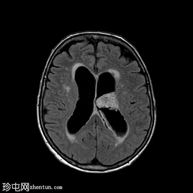 肾细胞癌脉络丛及胰腺转移