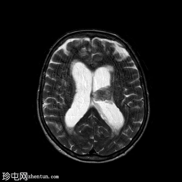 肾细胞癌脉络丛及胰腺转移