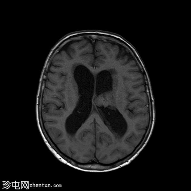 肾细胞癌脉络丛及胰腺转移