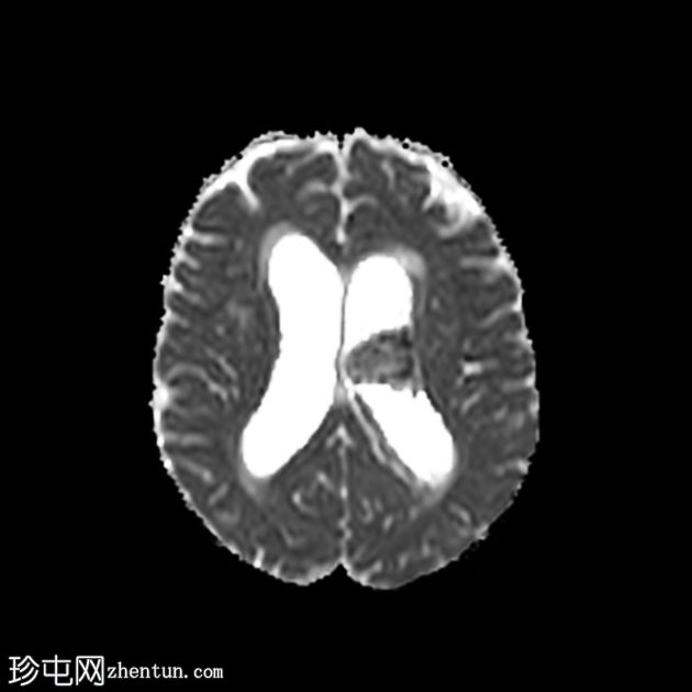 肾细胞癌脉络丛及胰腺转移