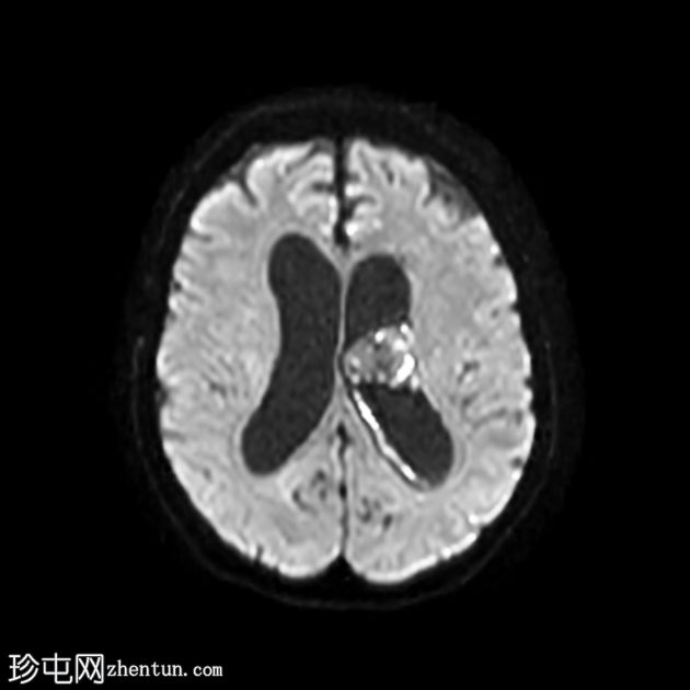 肾细胞癌脉络丛及胰腺转移