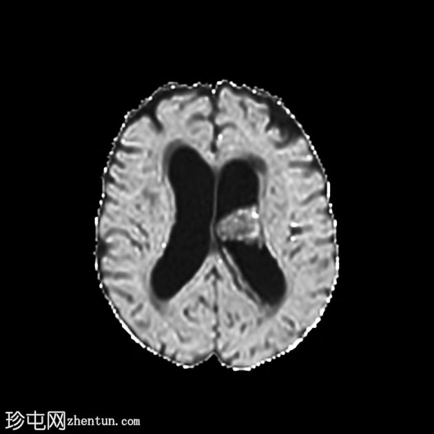 肾细胞癌脉络丛及胰腺转移