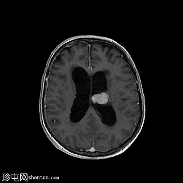 肾细胞癌脉络丛及胰腺转移