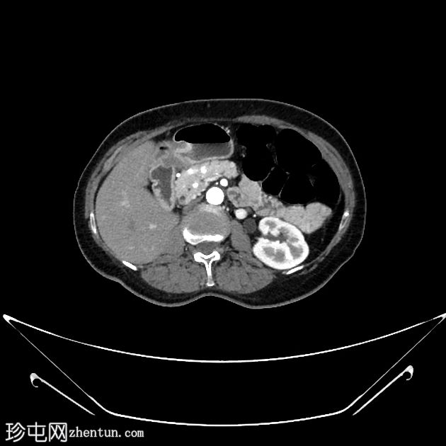 肾细胞癌脉络丛及胰腺转移