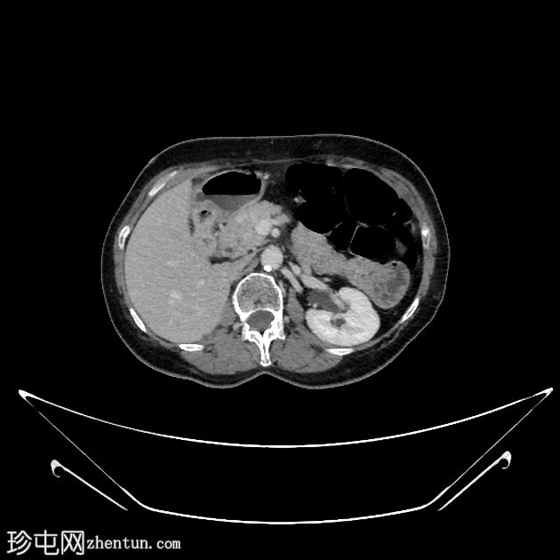 肾细胞癌脉络丛及胰腺转移