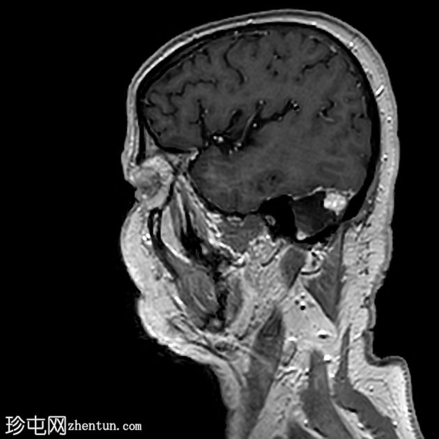 血管母细胞瘤 - 复发