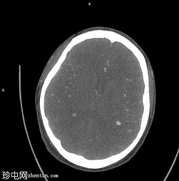 感染性心内膜炎继发的颅内真菌性动脉瘤