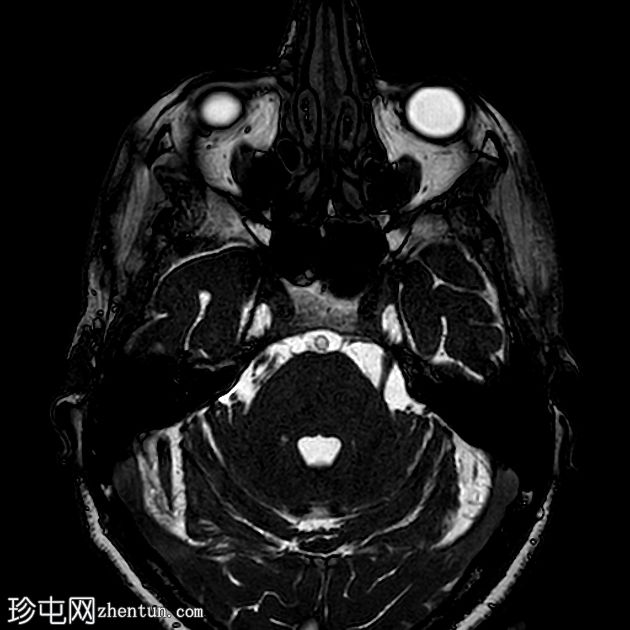 神经血管压迫综合征——三叉神经