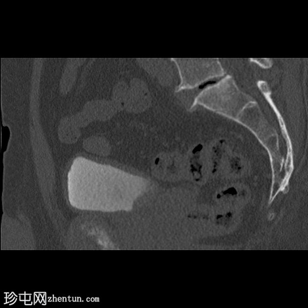 膀胱内输尿管囊肿