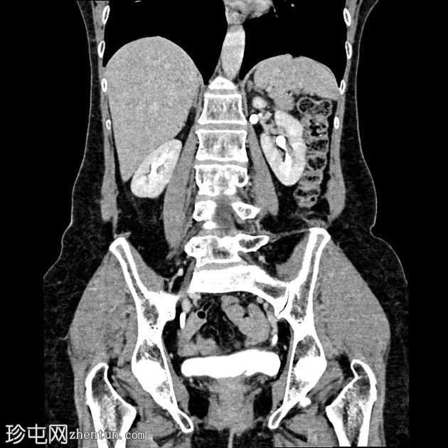 双侧输尿管裂