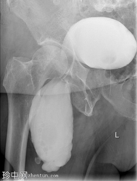 膀胱疝（阴囊膀胱膨出）